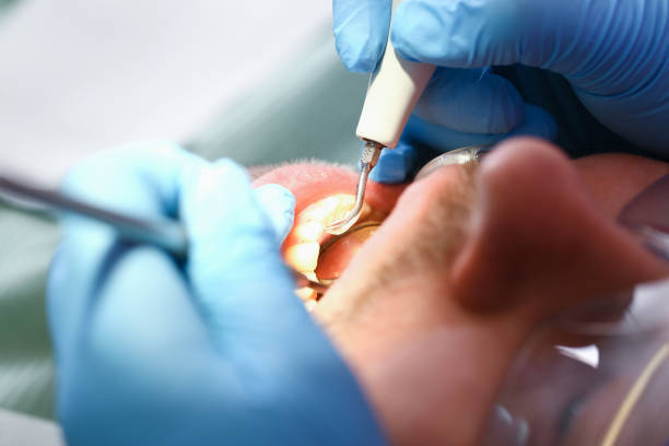 Best Emergency Dental Extractions in Lake Tapps, WA