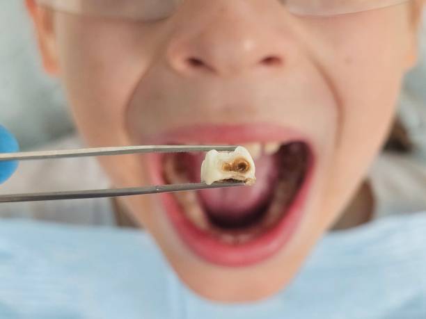 Best Emergency Dentist for Lost Fillings or Crowns in Lake Tapps, WA