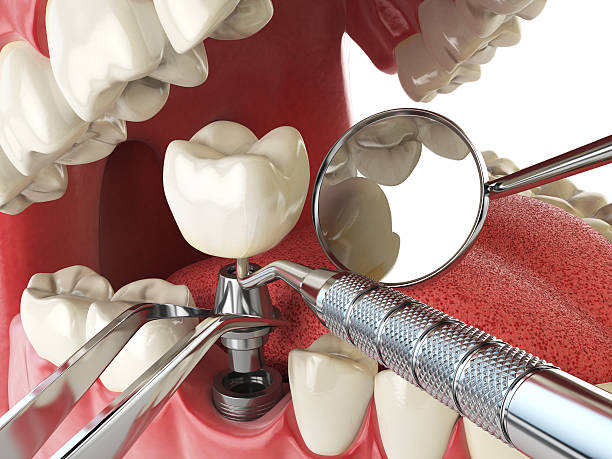 Best Emergency Dental Extractions in Lake Tapps, WA